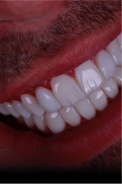 Imagem sobre clareamento dental