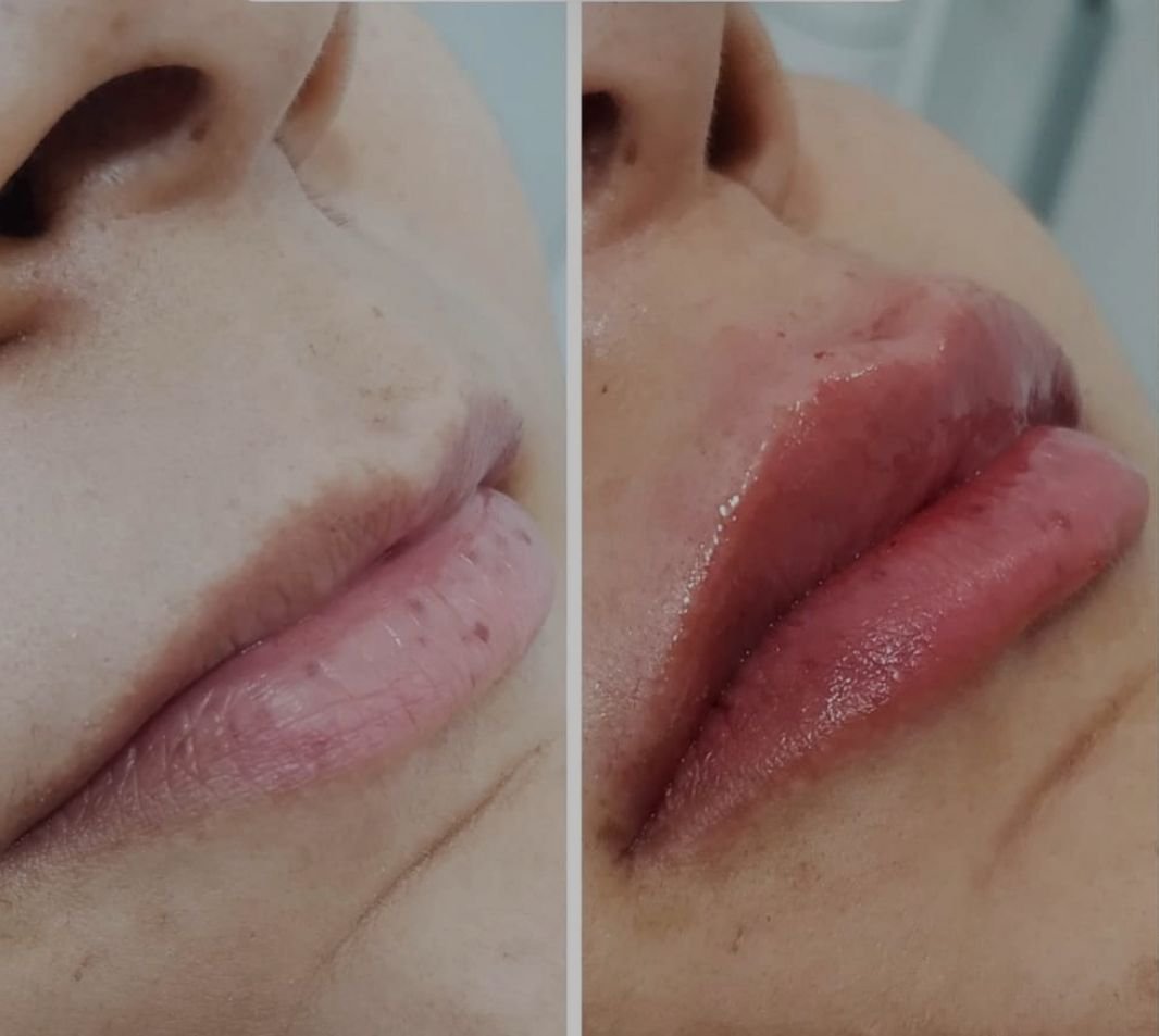 Preenchimento labial 1