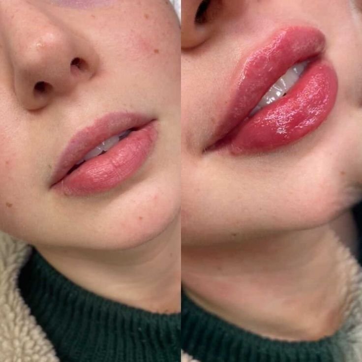 Preenchimento labial 2